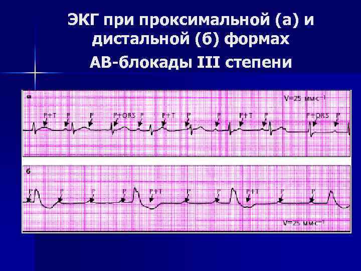 ЭКГ при проксимальной (а) и дистальной (б) формах АВ-блокады III степени 