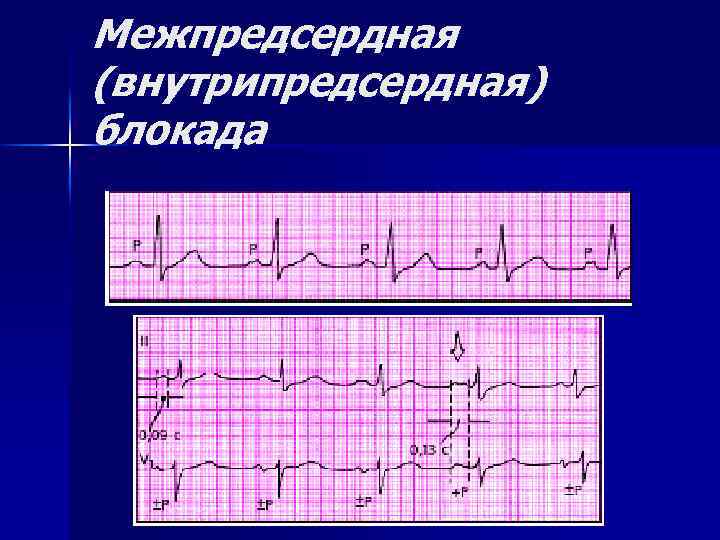 Межпредсердная (внутрипредсердная) блокада 
