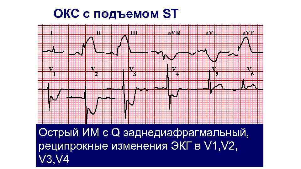 Экг v1 v2 v3