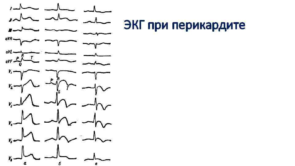 ЭКГ при перикардите 