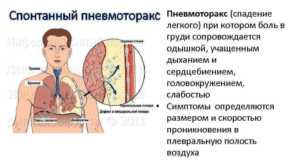 Рено кардиальный синдром