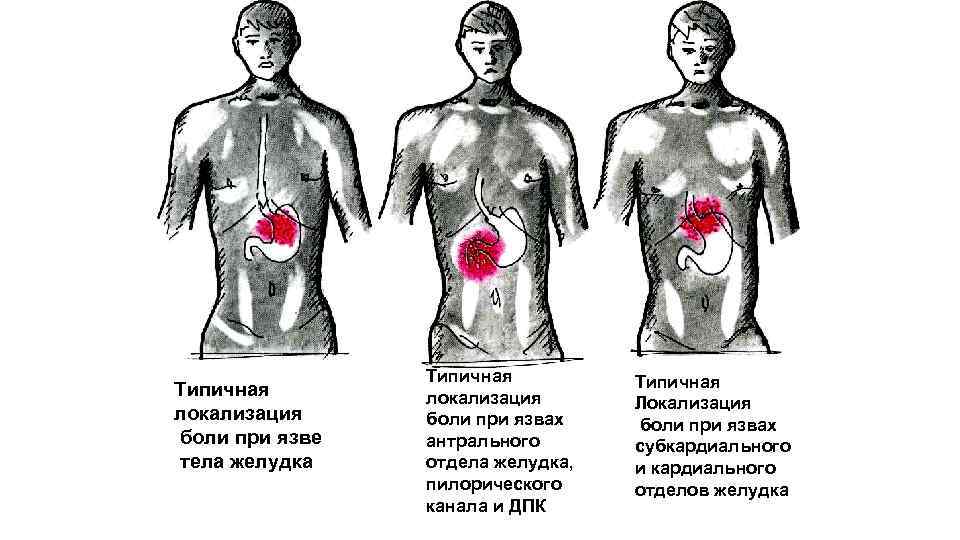 Типичная локализация боли при язве тела желудка Типичная локализация боли при язвах антрального отдела