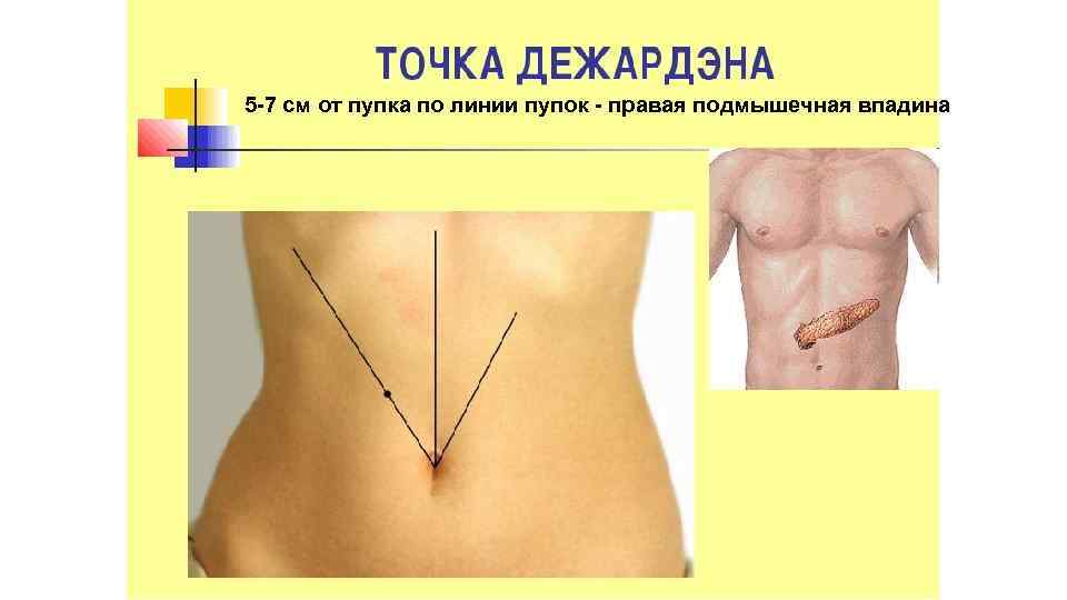 5 -7 см от пупка по линии пупок - правая подмышечная впадина 
