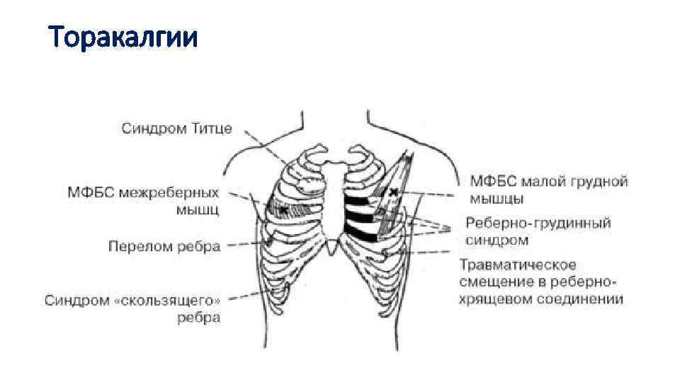 Торакалгии 