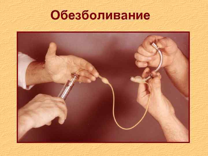 Обезболивание 