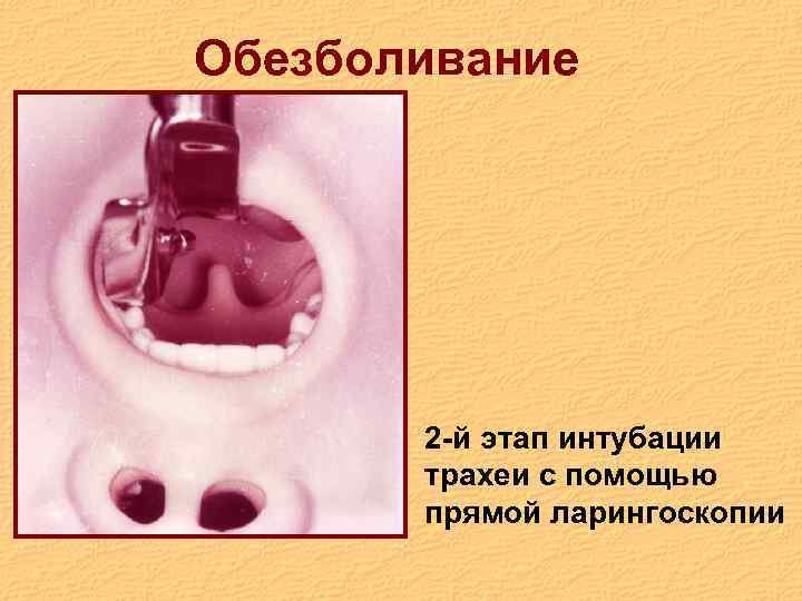 Обезболивание 2 -й этап интубации трахеи с помощью прямой ларингоскопии 
