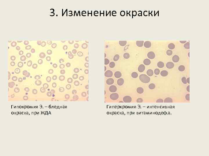 3. Изменение окраски Гипохромия Э. – бледная окраска, при ЖДА Гиперхромия Э. – интенсивная