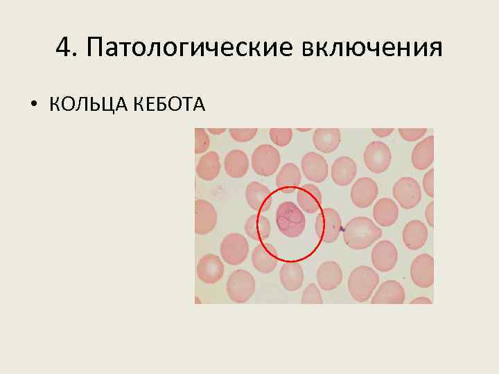 4. Патологические включения • КОЛЬЦА КЕБОТА 