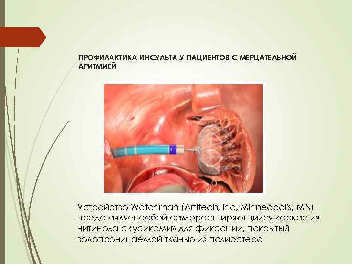ПРОФИЛАКТИКА ИНСУЛЬТА У ПАЦИЕНТОВ С МЕРЦАТЕЛЬНОЙ АРИТМИЕЙ Устройство Watchman (Artitech, Inc, Minneapolis, MN) представляет
