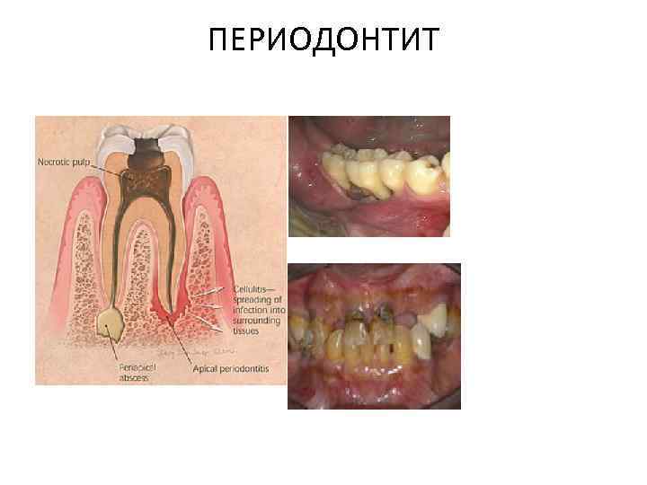 ПЕРИОДОНТИТ 