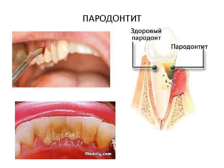 ПАРОДОНТИТ 