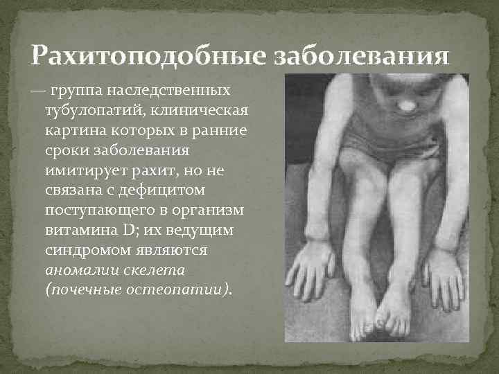Рахитоподобные заболевания — группа наследственных тубулопатий, клиническая картина которых в ранние сроки заболевания имитирует