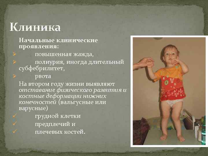 Клиника Начальные клинические проявления: Ø повышенная жажда, Ø полиурия, иногда длительный субфебрилитет, Ø рвота