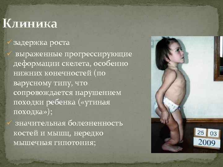 Клиника ü задержка роста ü выраженные прогрессирующие деформации скелета, особенно нижних конечностей (по варусному