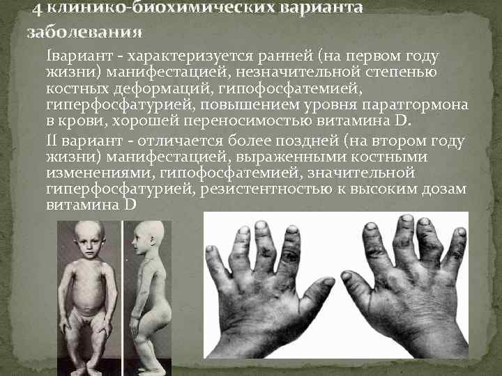  4 клинико-биохимических варианта заболевания Iвариант - характеризуется ранней (на первом году жизни) манифестацией,