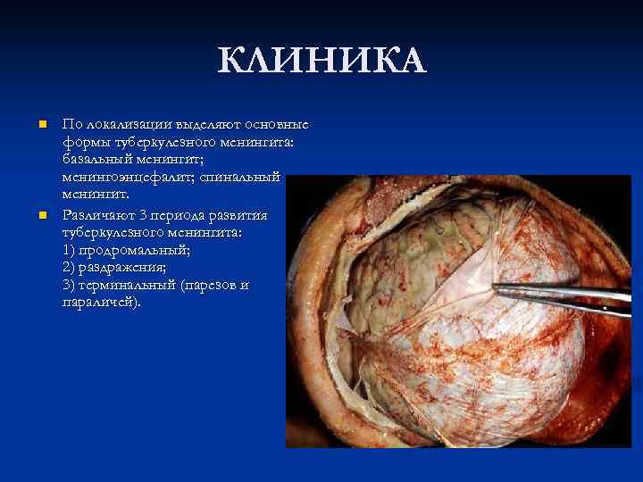 КЛИНИКА n n По локализации выделяют основные формы туберкулезного менингита: базальный менингит; менингоэнцефалит; спинальный