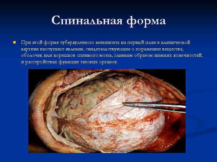 Спинальная форма n При этой форме туберкулезного менингита на первый план в клинической картине