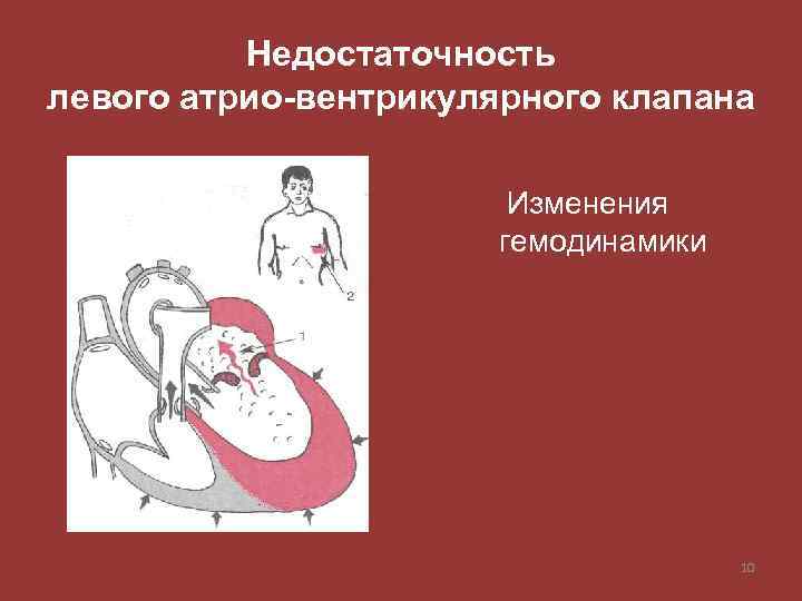Недостаточность левого атрио-вентрикулярного клапана Изменения гемодинамики 10 