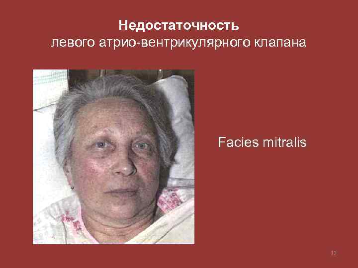 Недостаточность левого атрио-вентрикулярного клапана Facies mitralis 12 
