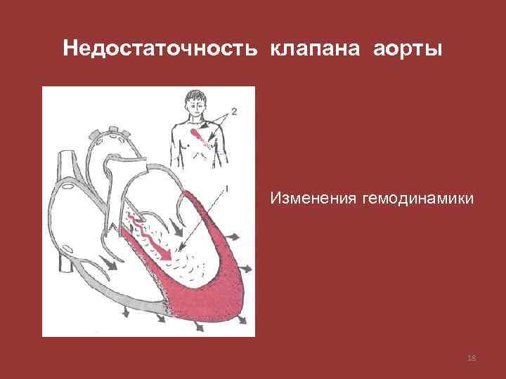 Недостаточность клапана аорты Изменения гемодинамики 18 