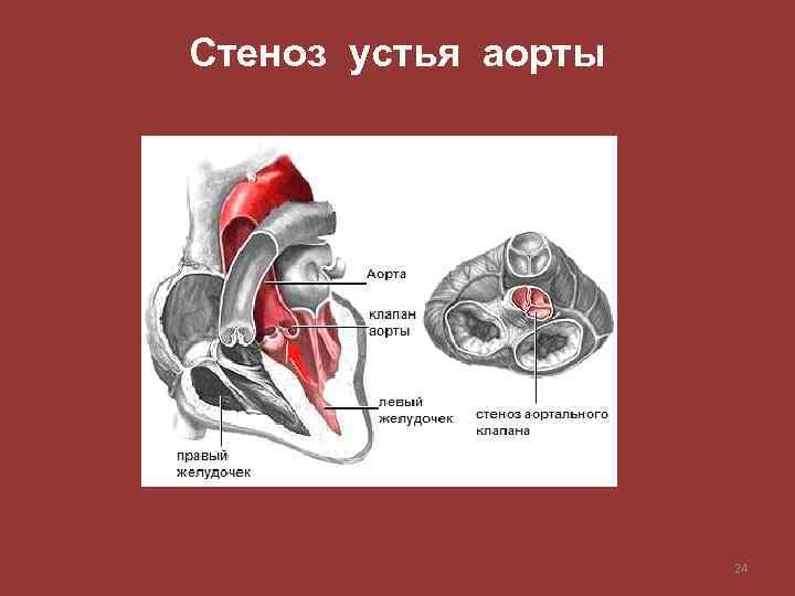 Стеноз устья аорты 24 