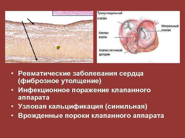  • Ревматические заболевания сердца (фиброзное утолщение) • Инфекционное поражение клапанного аппарата • Узловая