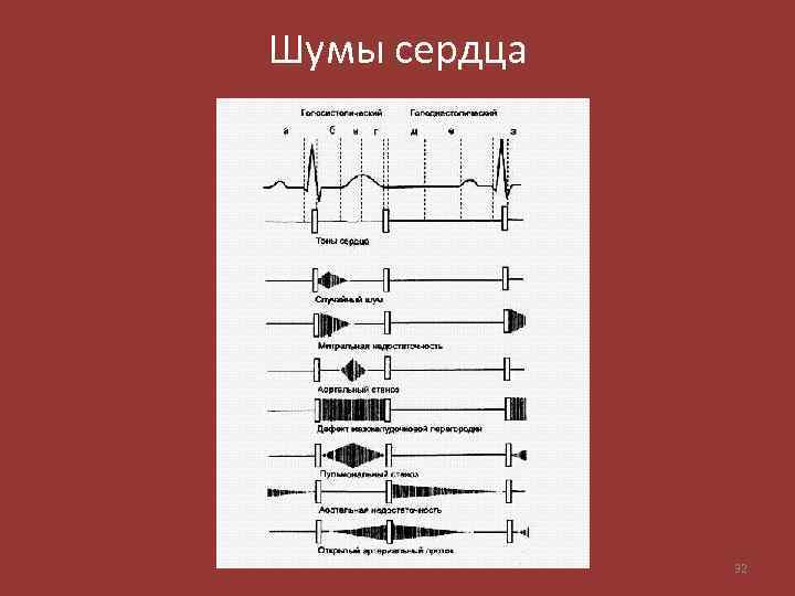 Шумы сердца 32 