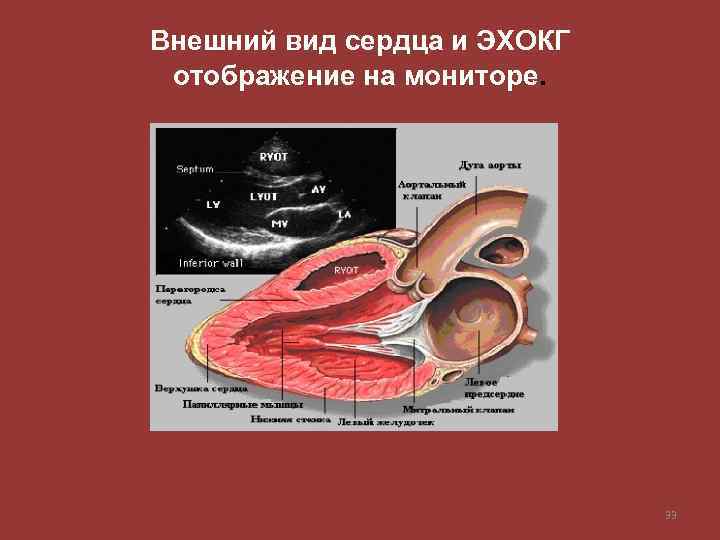 Внешний вид сердца и ЭХОКГ отображение на мониторе. 33 