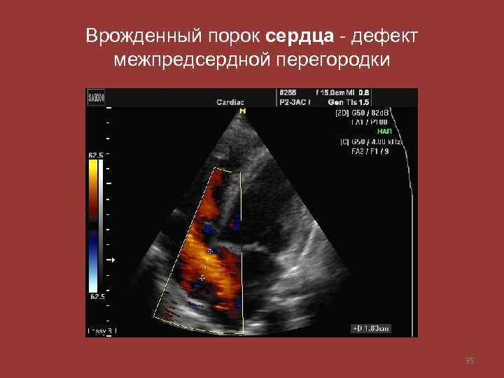 Врожденный порок сердца - дефект межпредсердной перегородки 35 