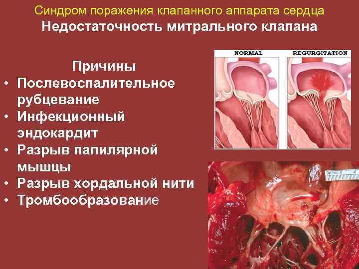 Недостаточность митрального клапана причины