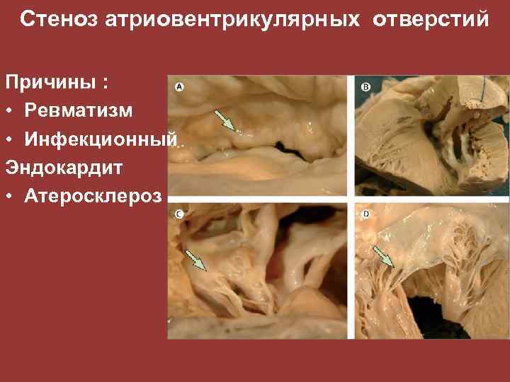 Стеноз атриовентрикулярных отверстий Причины : • Ревматизм • Инфекционный Эндокардит • Атеросклероз 