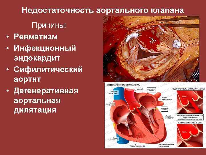 Недостаточность аортального клапана • • Причины: Ревматизм Инфекционный эндокардит Сифилитический аортит Дегенеративная аортальная дилятация