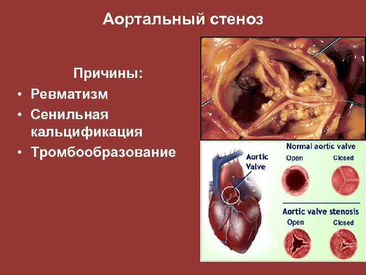 Аортальный стеноз Причины: • Ревматизм • Сенильная кальцификация • Тромбообразование 