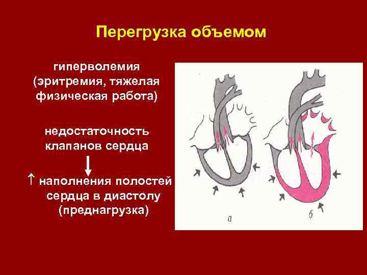 Патологическая физиология морфология синдрома острой коронарной сердечной и