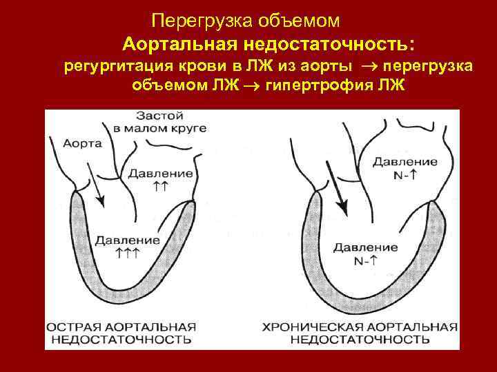 Перегрузка объемом Аортальная недостаточность: регургитация крови в ЛЖ из аорты перегрузка объемом ЛЖ гипертрофия