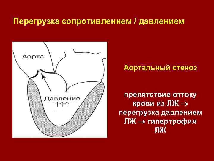 Перегрузка сопротивлением / давлением Аортальный стеноз препятствие оттоку крови из ЛЖ перегрузка давлением ЛЖ