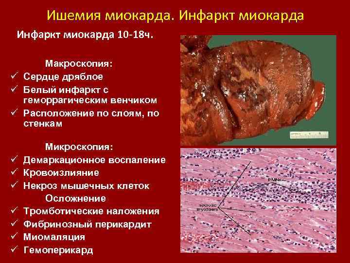 Ишемия миокарда. Инфаркт миокарда 10 -18 ч. Макроскопия: ü Сердце дряблое ü Белый инфаркт