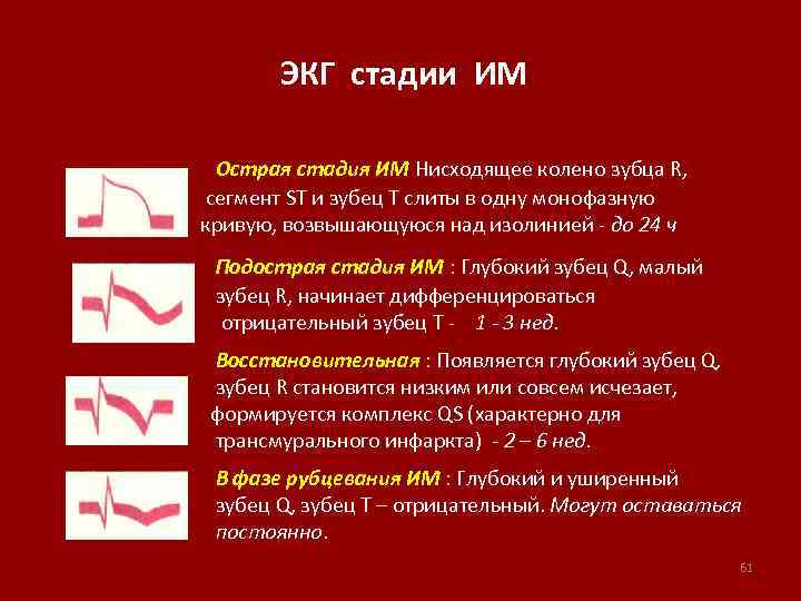 ЭКГ стадии ИМ Острая стадия ИМ Нисходящее колено зубца R, сегмент ST и зубец