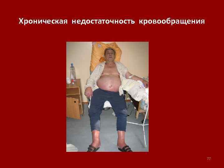 Хроническая недостаточность кровообращения 77 