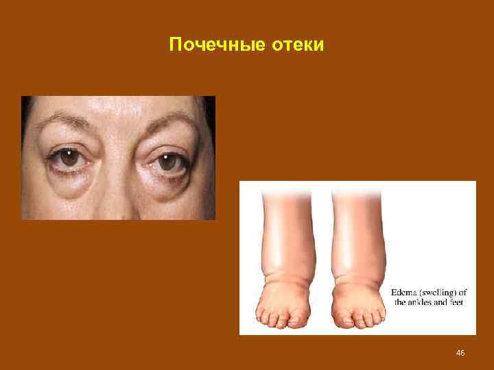 Почечные отеки 46 