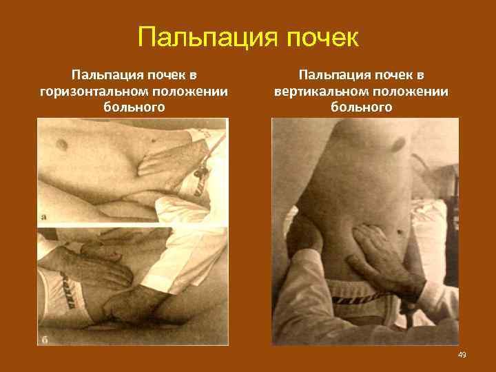 Пальпация почек в горизонтальном положении больного Пальпация почек в вертикальном положении больного 49 