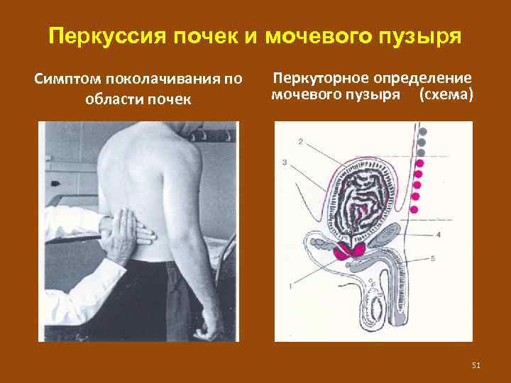 Перкуссия почек и мочевого пузыря Симптом поколачивания по области почек Перкуторное определение мочевого пузыря