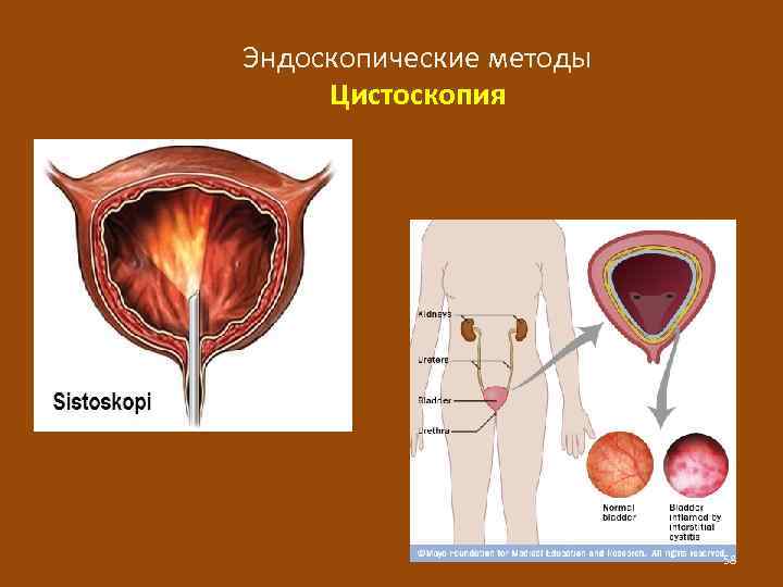 Эндоскопические методы Цистоскопия 58 