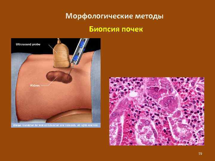 Морфологические методы Биопсия почек 59 