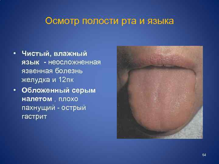 Осмотр полости рта и языка • Чистый, влажный язык - неосложненная язвенная болезнь желудка