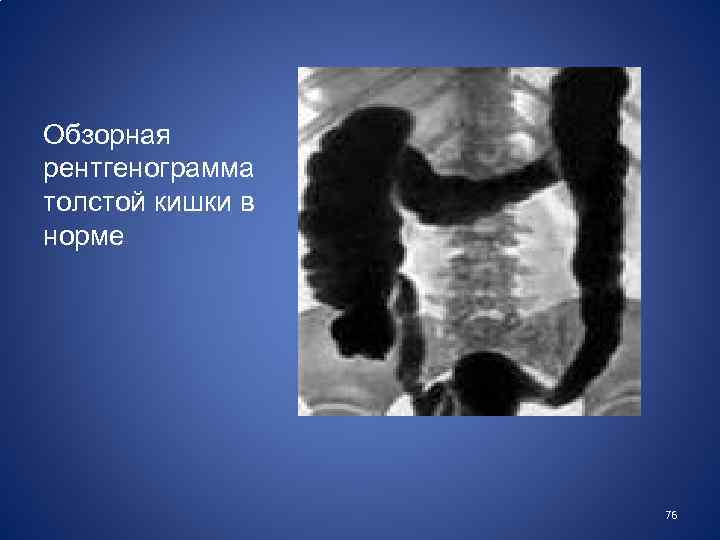 Обзорная рентгенограмма толстой кишки в норме 76 