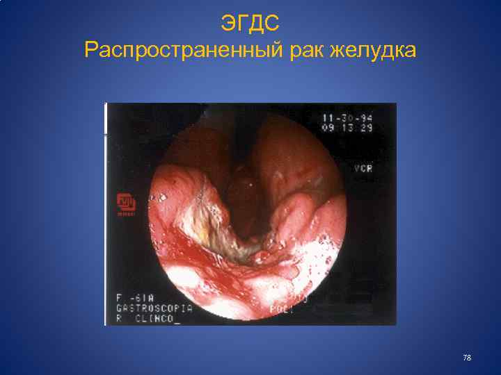  ЭГДС Распространенный рак желудка 78 