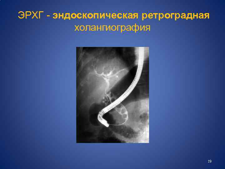  ЭРХГ - эндоскопическая ретроградная холангиография 19 