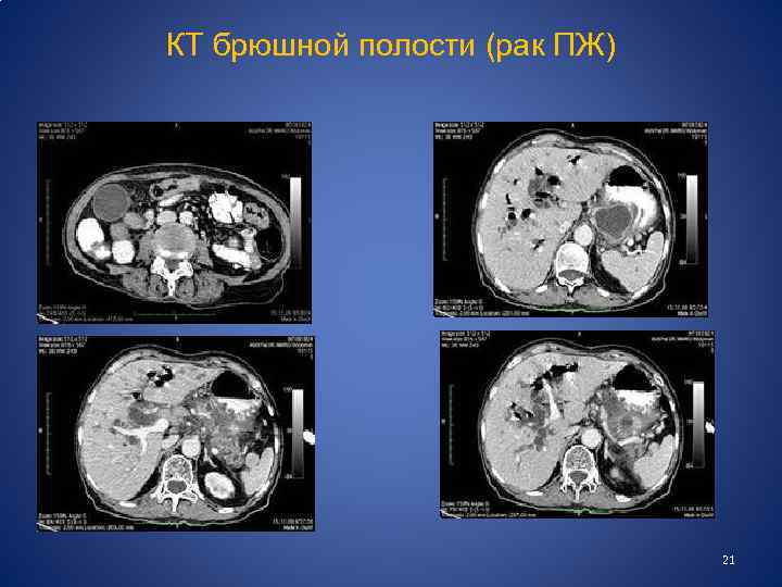 КТ брюшной полости (рак ПЖ) 21 