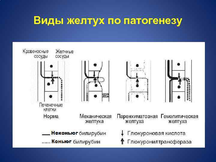 Виды желтух по патогенезу 